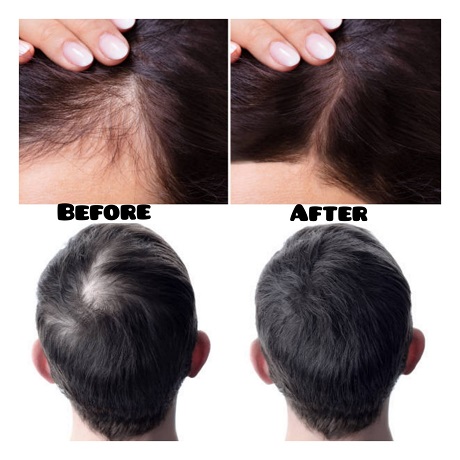 Know the symptoms of hair fall and get hair treatment