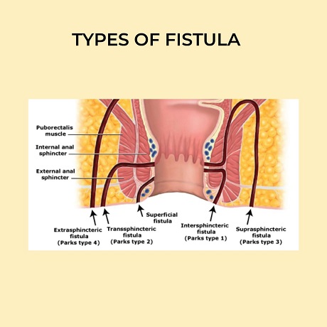 Types of fistula and get a fistula treatment without surgery