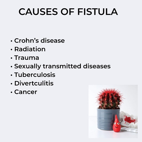 Know the symptoms of fistula and get fistula treatment without surgery