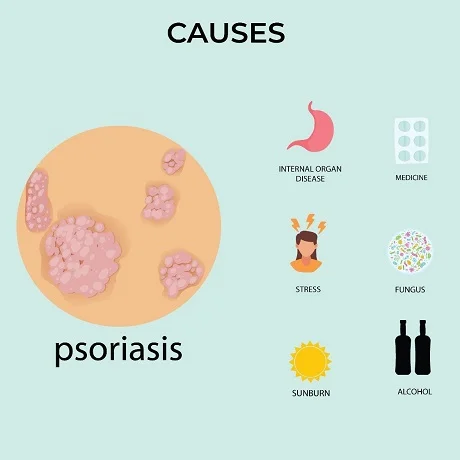 Causes of psoriasis and psoriaisis treatment