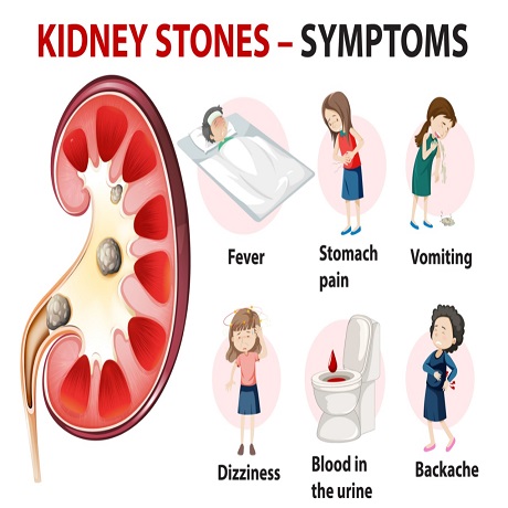 Symptoms of kidney stone
