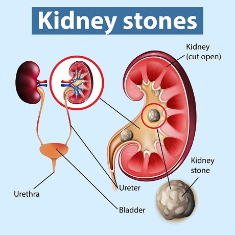 What is kidney stone? and th symptoms of kidney stone