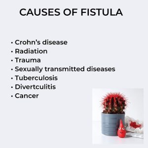 “Fistula and Anal Cancer: Understanding the Potential Link”